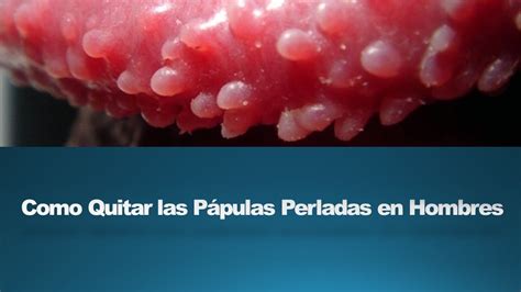 Pápulas perladas en el glande: causas y tratamiento